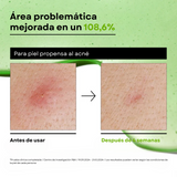 Sérum Calmante para enrojecimiento con Ácido Azelaico 10 y Ácido Hialurónico